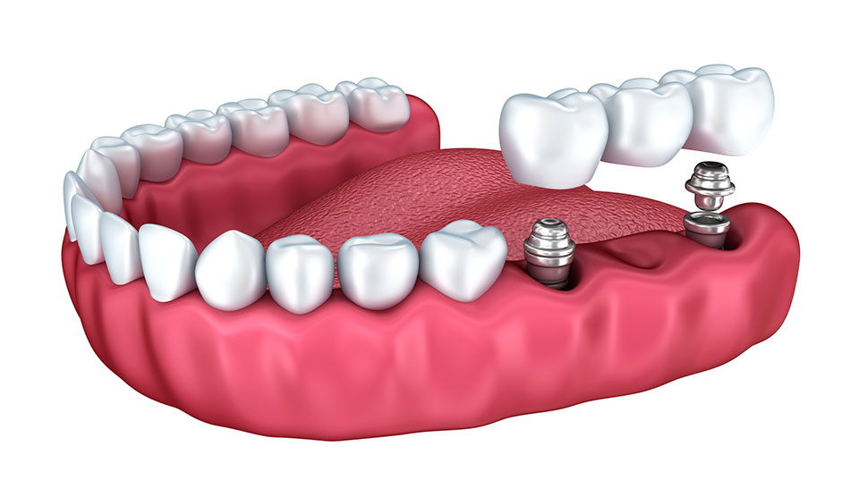 Dental implants